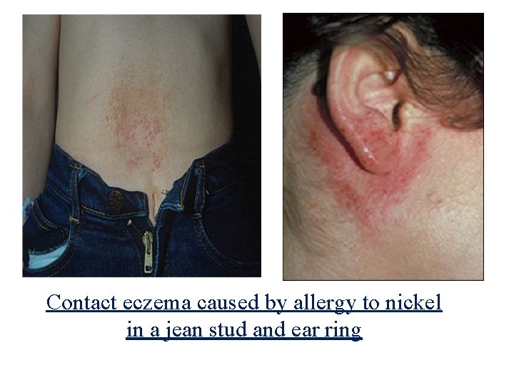 Contact eczema caused by allergy to nickel in a jean stud and ear ring