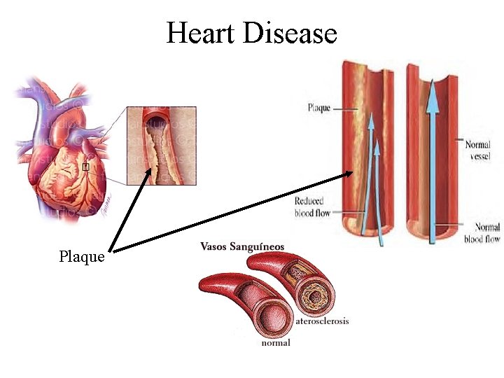 Heart Disease Plaque 