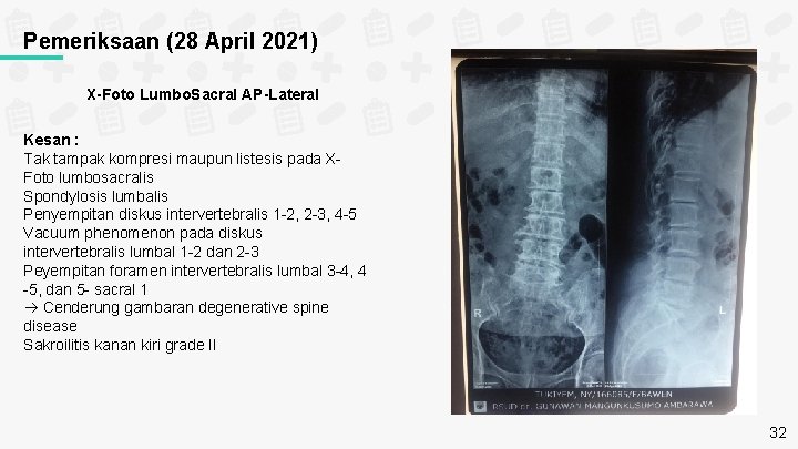 Pemeriksaan (28 April 2021) X-Foto Lumbo. Sacral AP-Lateral Kesan : Tak tampak kompresi maupun