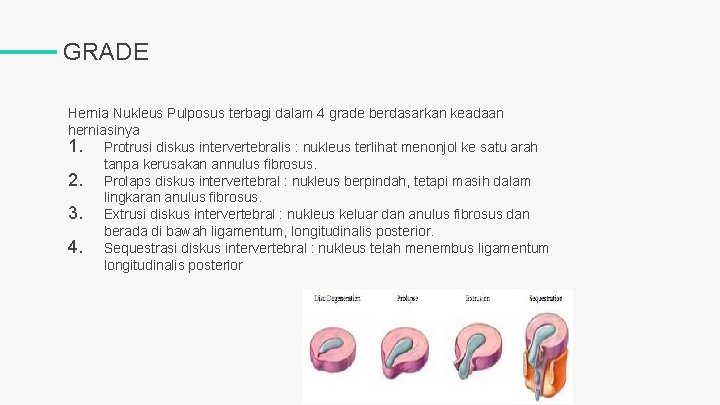 GRADE Hernia Nukleus Pulposus terbagi dalam 4 grade berdasarkan keadaan herniasinya 1. Protrusi diskus