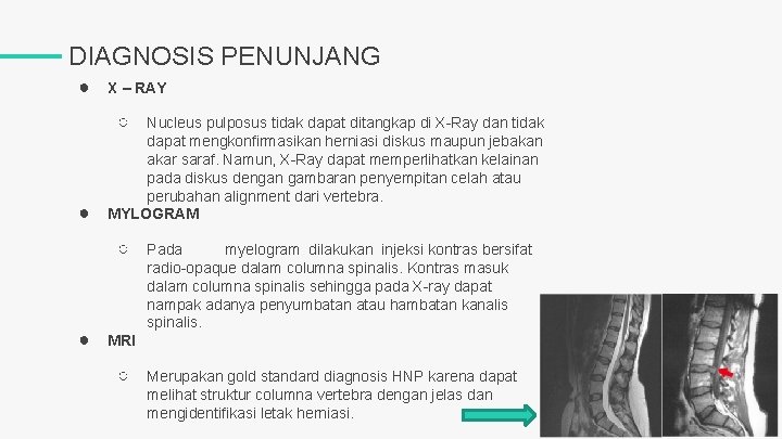 DIAGNOSIS PENUNJANG ● X – RAY ○ ● Nucleus pulposus tidak dapat ditangkap di