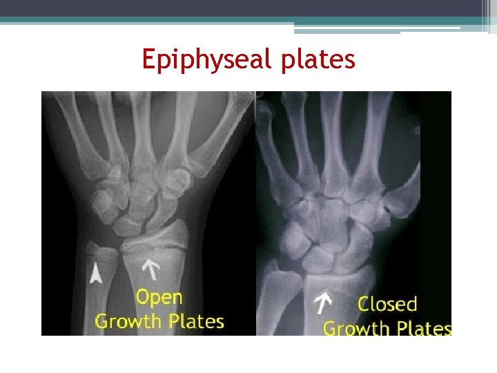 Epiphyseal plates 