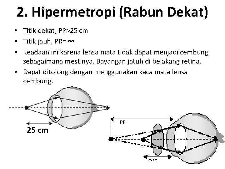 2. Hipermetropi (Rabun Dekat) • Titik dekat, PP>25 cm • Titik jauh, PR= ∞