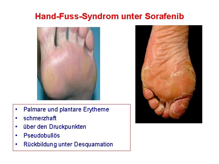 Hand-Fuss-Syndrom unter Sorafenib • • • Palmare und plantare Erytheme schmerzhaft über den Druckpunkten