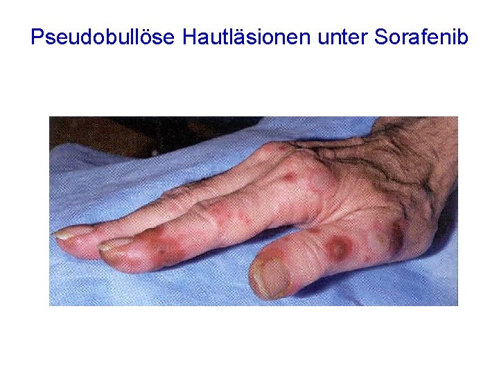 Pseudobullöse Hautläsionen unter Sorafenib 