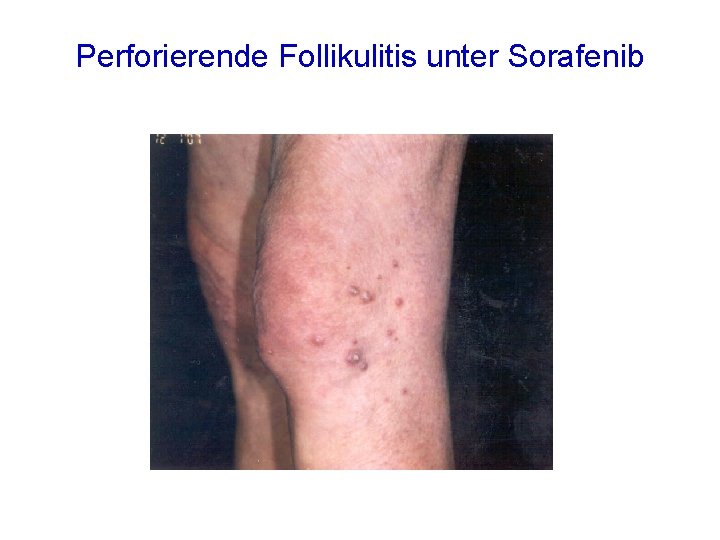 Perforierende Follikulitis unter Sorafenib 