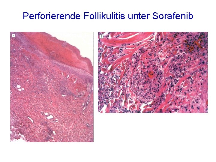 Perforierende Follikulitis unter Sorafenib 