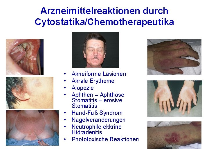 Arzneimittelreaktionen durch Cytostatika/Chemotherapeutika • • Akneiforme Läsionen Akrale Erytheme Alopezie Aphthen – Aphthöse Stomatitis