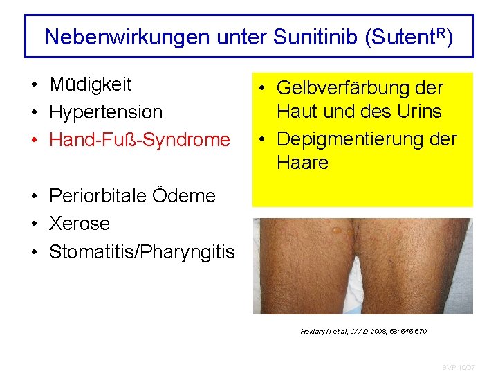 Nebenwirkungen unter Sunitinib (Sutent. R) • Müdigkeit • Hypertension • Hand-Fuß-Syndrome • Gelbverfärbung der