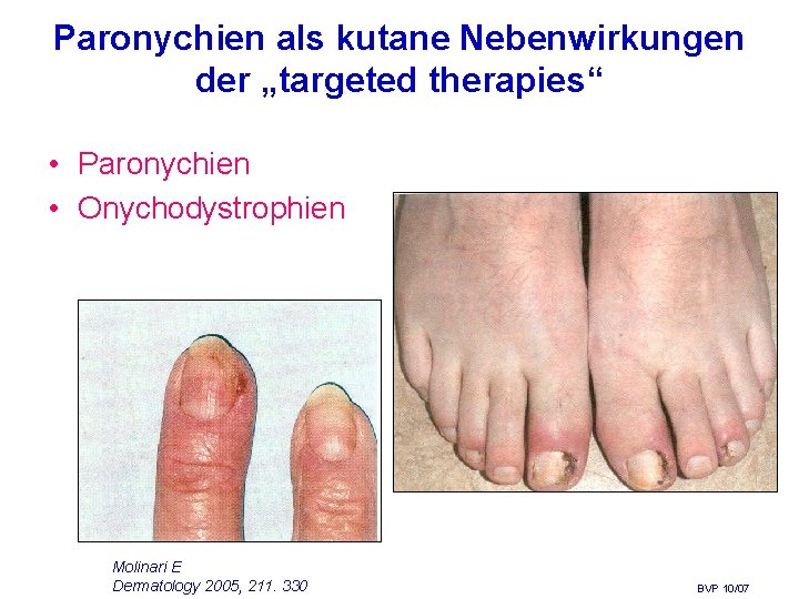 Paronychien als kutane Nebenwirkungen der „targeted therapies“ • Paronychien • Onychodystrophien Molinari E Dermatology