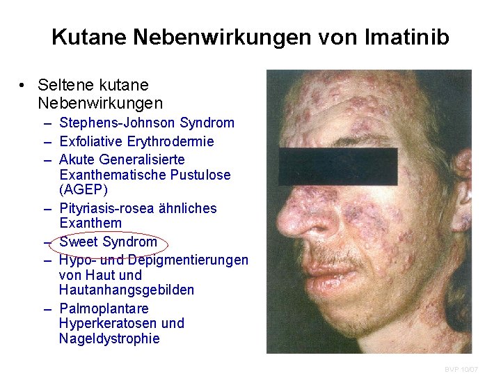 Kutane Nebenwirkungen von Imatinib • Seltene kutane Nebenwirkungen – Stephens-Johnson Syndrom – Exfoliative Erythrodermie