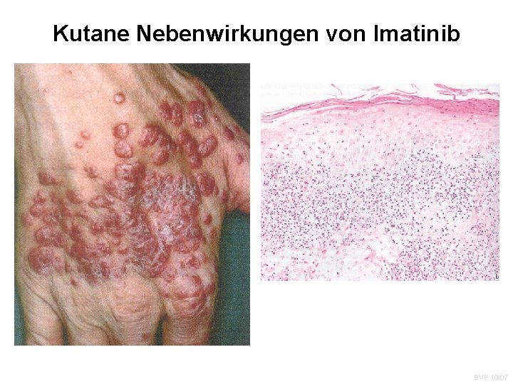 Kutane Nebenwirkungen von Imatinib BVP 10/07 