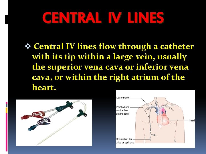 CENTRAL IV LINES v Central IV lines flow through a catheter with its tip