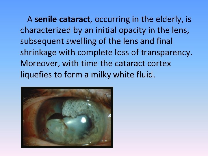 A senile cataract, occurring in the elderly, is characterized by an initial opacity in