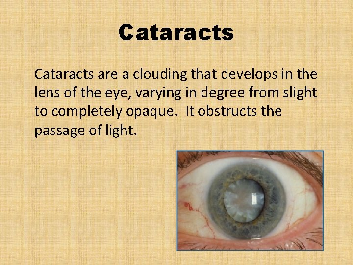 Cataracts are a clouding that develops in the lens of the eye, varying in