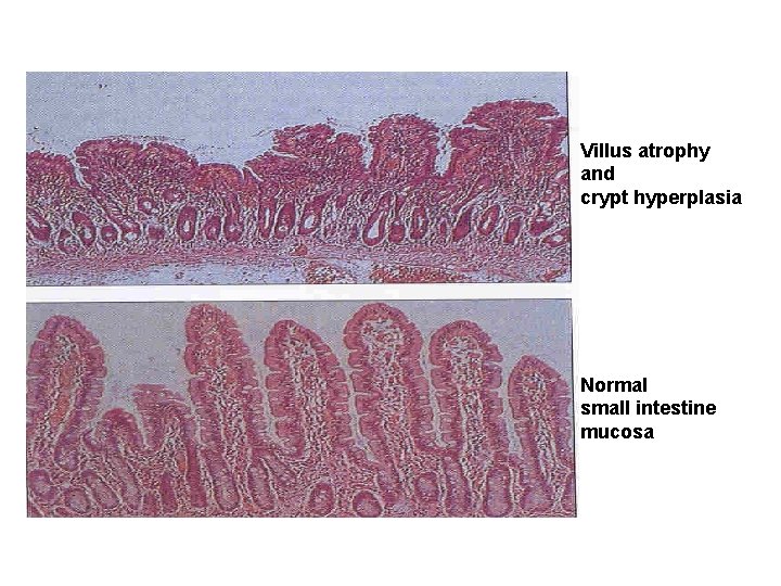 Villus atrophy and crypt hyperplasia Normal small intestine mucosa 