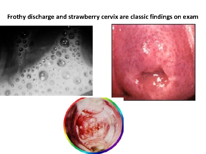 Frothy discharge and strawberry cervix are classic findings on exam 