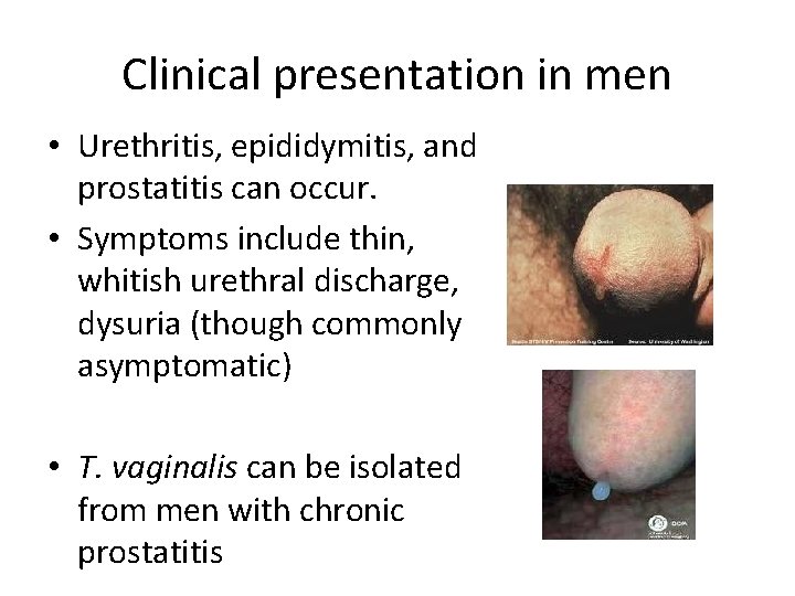 Clinical presentation in men • Urethritis, epididymitis, and prostatitis can occur. • Symptoms include