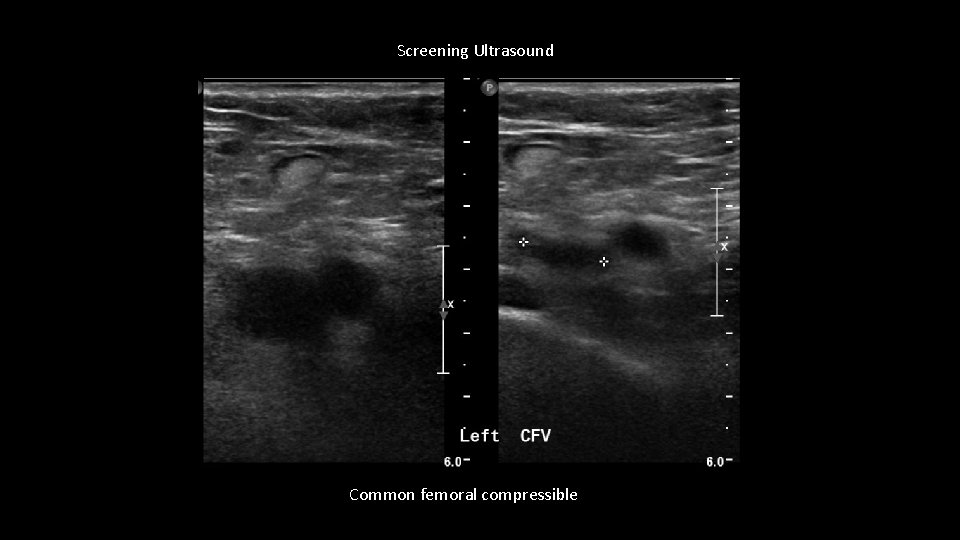 Screening Ultrasound Common femoral compressible 