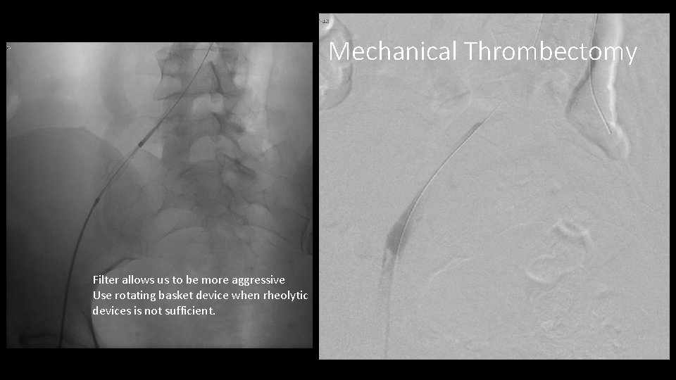 Mechanical Thrombectomy Filter allows us to be more aggressive Use rotating basket device when
