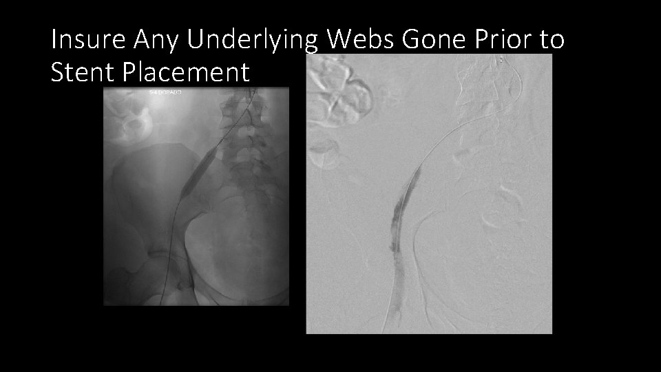 Insure Any Underlying Webs Gone Prior to Stent Placement 