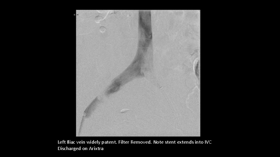 Left Iliac vein widely patent. Filter Removed. Note stent extends into IVC Discharged on