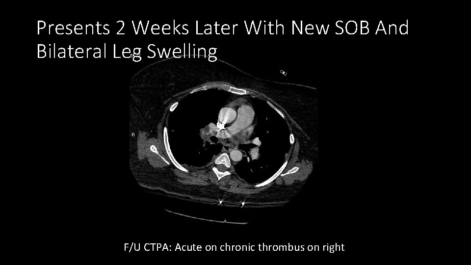 Presents 2 Weeks Later With New SOB And Bilateral Leg Swelling F/U CTPA: Acute