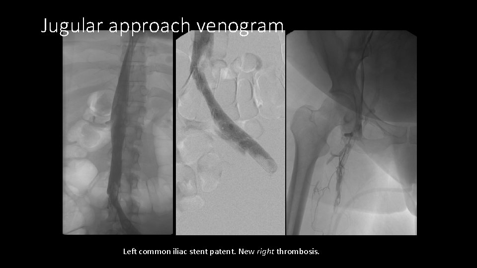 Jugular approach venogram Left common iliac stent patent. New right thrombosis. 
