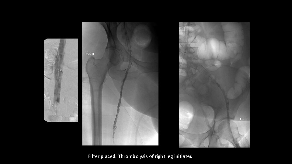 Filter placed. Thrombolysis of right leg initiated 