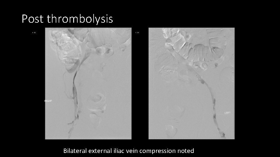 Post thrombolysis Bilateral external iliac vein compression noted 