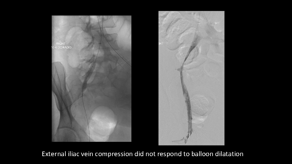 External iliac vein compression did not respond to balloon dilatation 