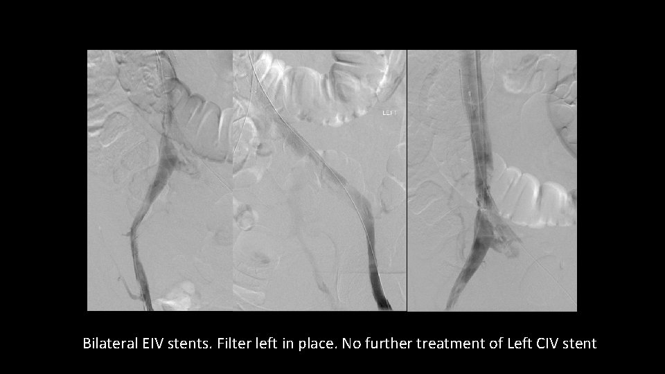 Bilateral EIV stents. Filter left in place. No further treatment of Left CIV stent