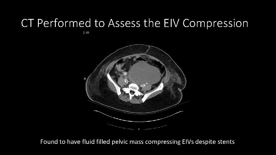 CT Performed to Assess the EIV Compression Found to have fluid filled pelvic mass