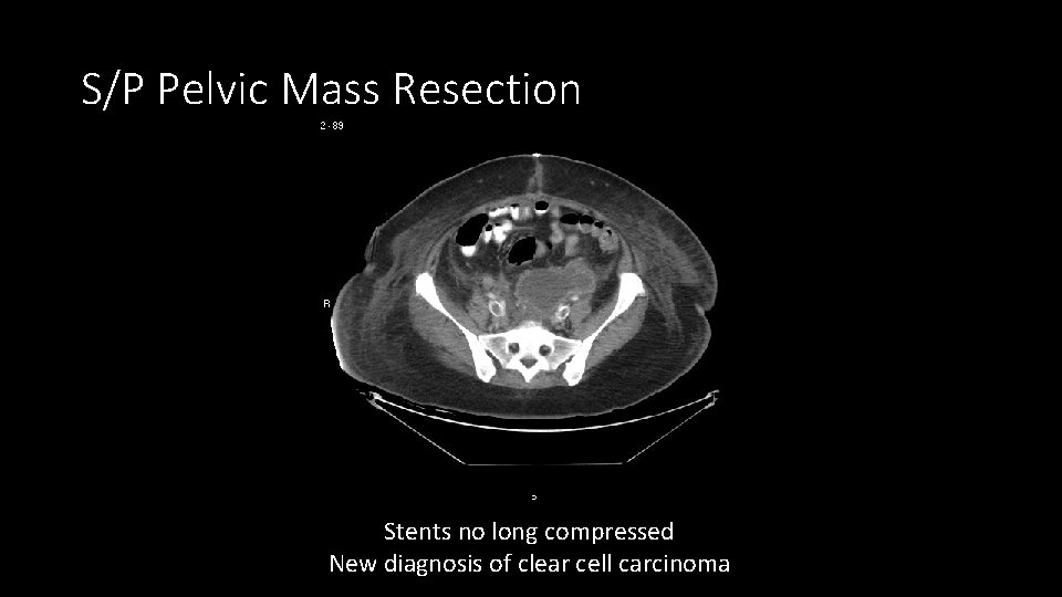 S/P Pelvic Mass Resection Stents no long compressed New diagnosis of clear cell carcinoma