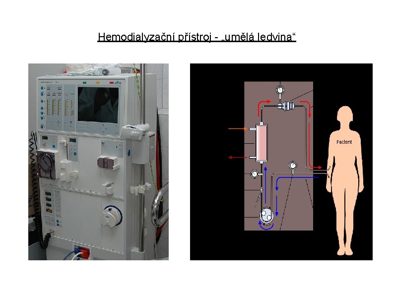 Hemodialyzační přístroj - „umělá ledvina“ 