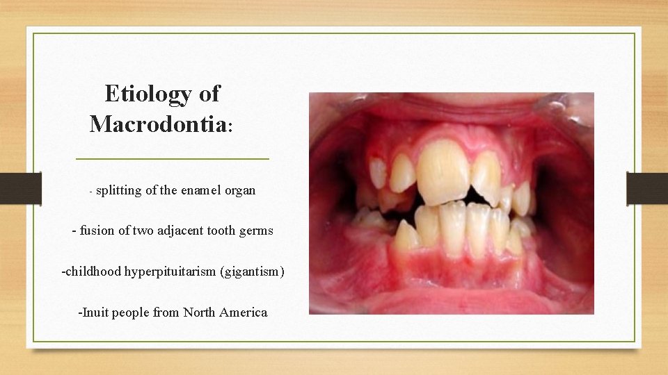 Etiology of Macrodontia: - splitting of the enamel organ - fusion of two adjacent