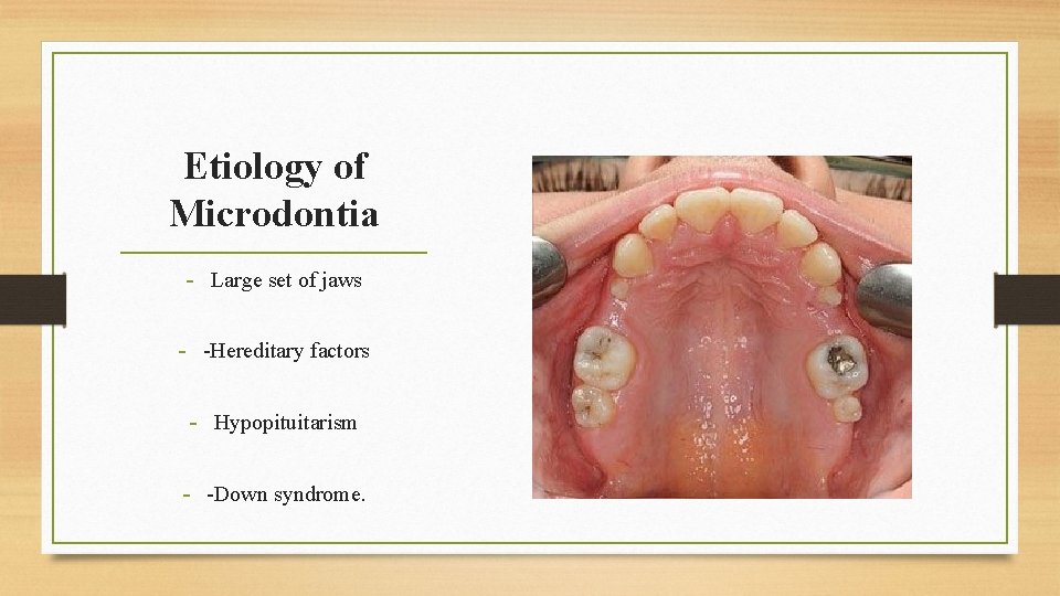 Etiology of Microdontia - Large set of jaws - -Hereditary factors - Hypopituitarism -