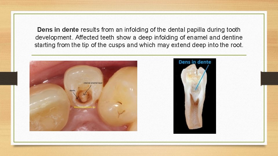 Dens in dente results from an infolding of the dental papilla during tooth development.