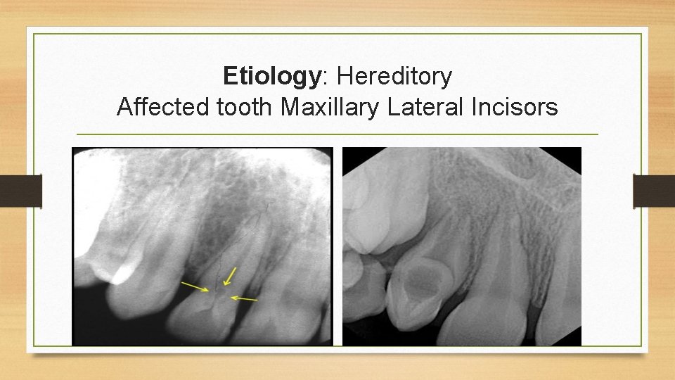 Etiology: Hereditory Affected tooth Maxillary Lateral Incisors 