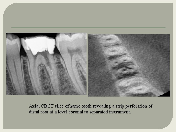 Axial CBCT slice of same tooth revealing a strip perforation of distal root at