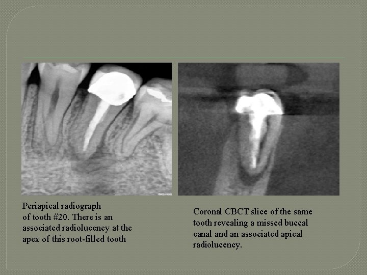 Periapical radiograph of tooth #20. There is an associated radiolucency at the apex of