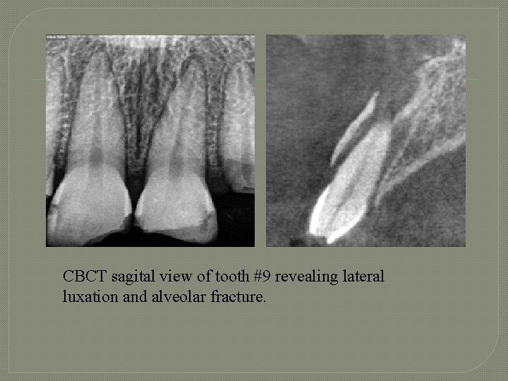 CBCT sagital view of tooth #9 revealing lateral luxation and alveolar fracture. 