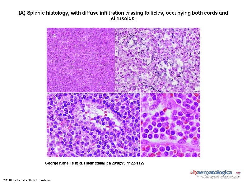 (A) Splenic histology, with diffuse infiltration erasing follicles, occupying both cords and sinusoids. George