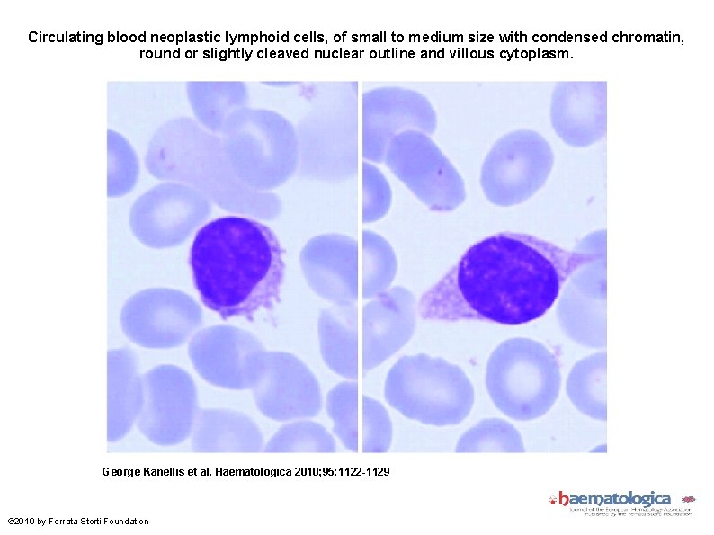 Circulating blood neoplastic lymphoid cells, of small to medium size with condensed chromatin, round