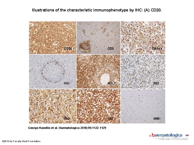 Illustrations of the characteristic immunophenotype by IHC: (A) CD 20. George Kanellis et al.