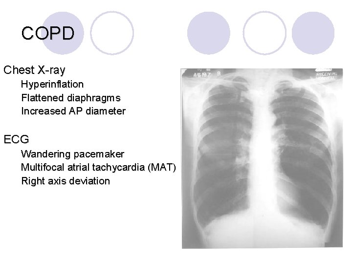 COPD Chest X-ray Hyperinflation Flattened diaphragms Increased AP diameter ECG Wandering pacemaker Multifocal atrial