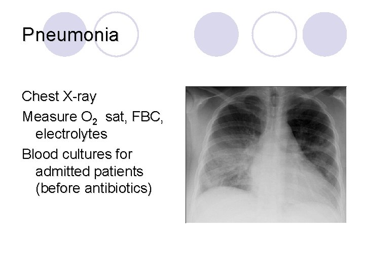 Pneumonia Chest X-ray Measure O 2 sat, FBC, electrolytes Blood cultures for admitted patients
