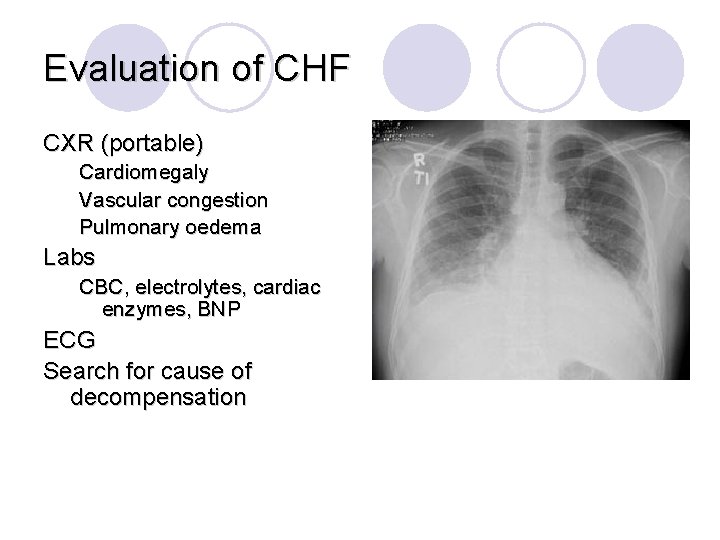 Evaluation of CHF CXR (portable) Cardiomegaly Vascular congestion Pulmonary oedema Labs CBC, electrolytes, cardiac