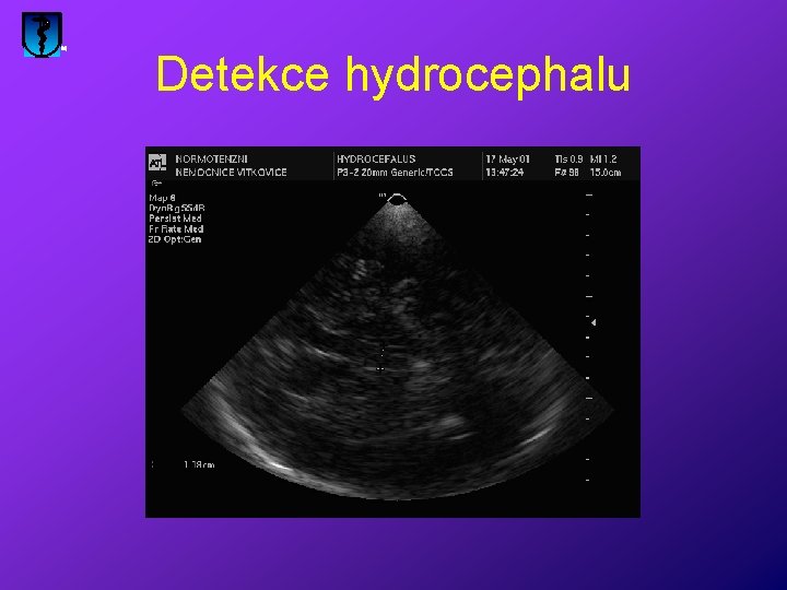 Detekce hydrocephalu 