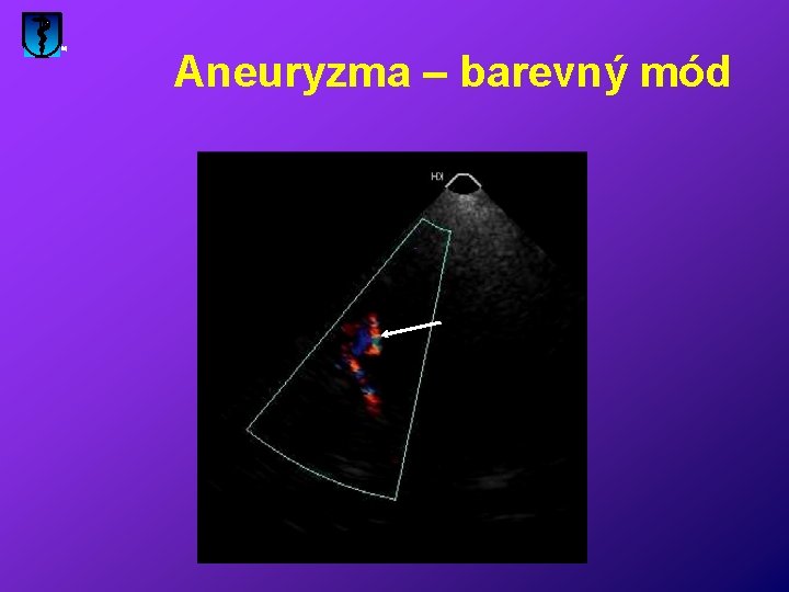 Aneuryzma – barevný mód 